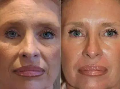 Ablative Laser Resurfacing